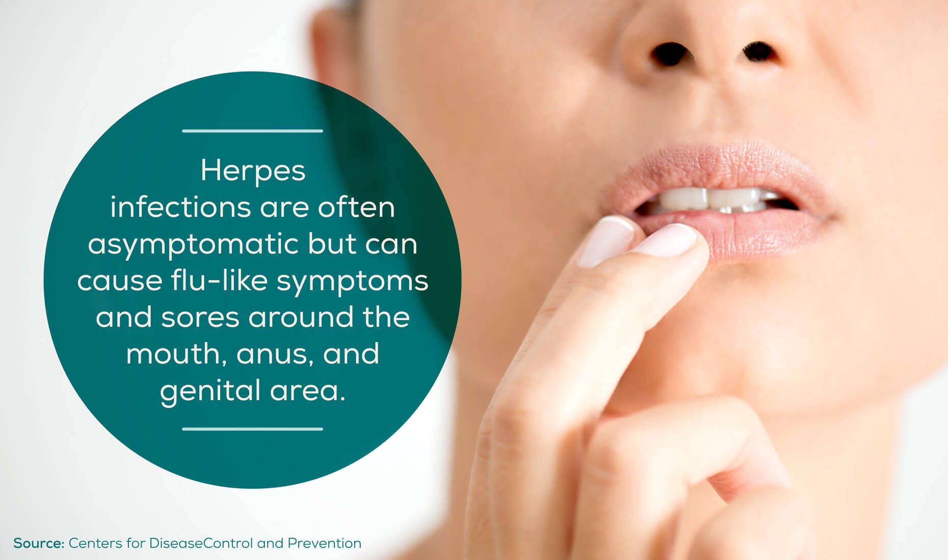 herpes-symptoms