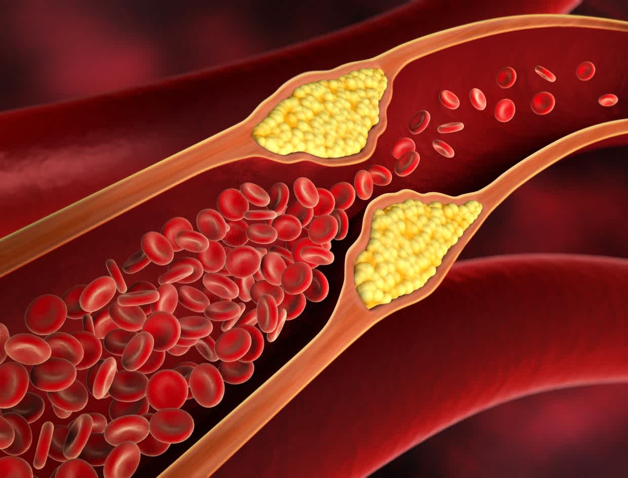 Illustration showing hypertension in artery contributing to cardiovascular disease